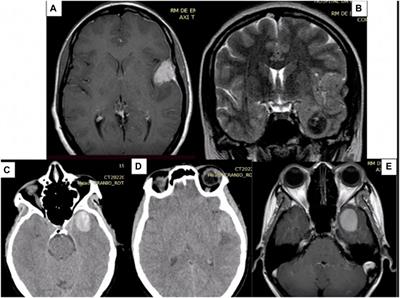 Supratentorial meningeal melanocytoma mimicking meningioma: case report and literature review